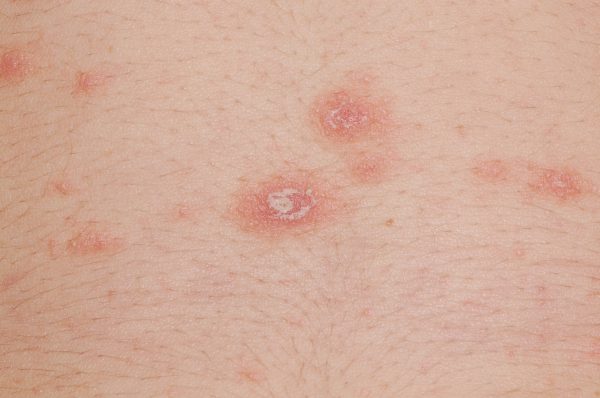 Pityriasis rosea Dr. Th. Gutersohn