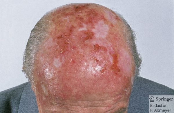 Keratosis actinica