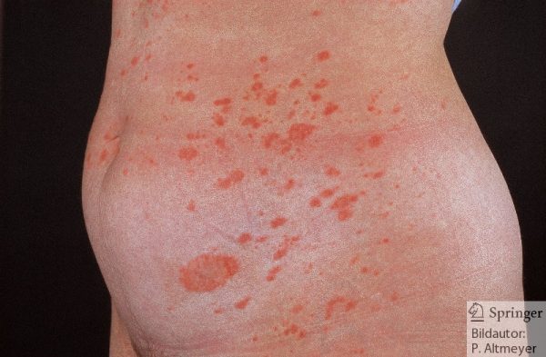 Pityriasis rosea Gibert